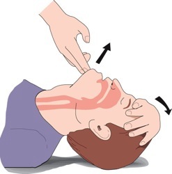 open airway no trauma